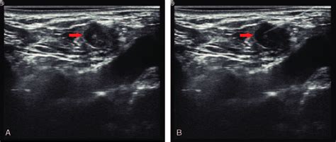 A Ultrasound Image Of A Suspicious Lymph Node The Red Arrow Shows