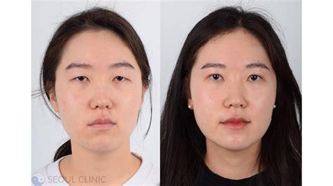 Double Eyelid Surgery Korea In 2024 Costs Clinics And More