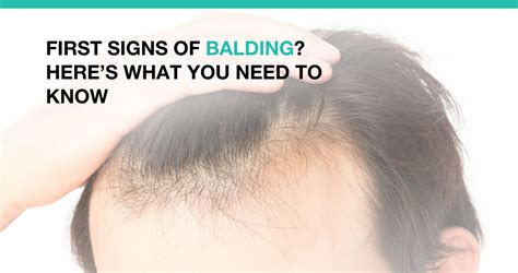 First Signs Of Balding Heres What You Need To Know Advanced Medical