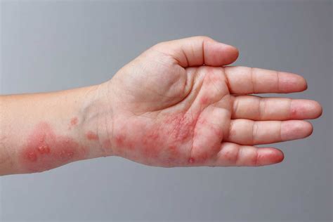 Itchy Skin Rash On Hands