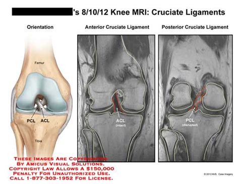 Magnetic resonance imaging (mri) has become an important tool in the proposed indications for mri after acl reconstruction include persistent knee instability, knee stiffness or pain, a new injury of. Knee MRI: Cruciate Ligaments