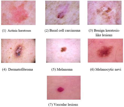 Skin Lesions Types With Chart Pictures Causes Treatme Vrogue Co