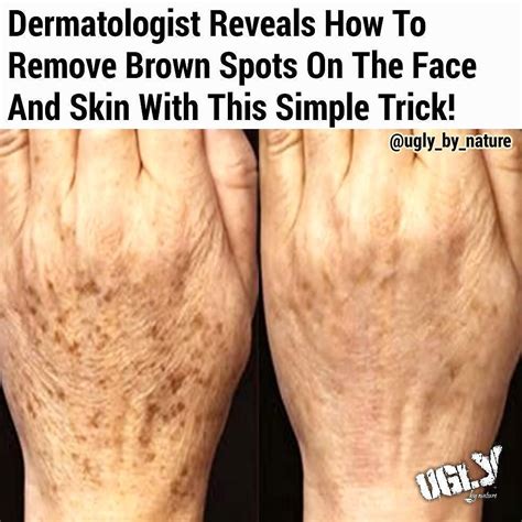 Numerous People Find The Age Spots On Their Skin A Huge Problem As They