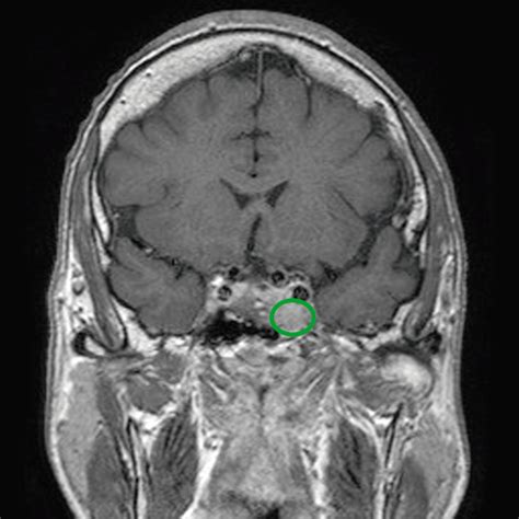 Delegát Veľký Klam Terorizmus Magnetic Resonance Imaging Of Pituitary
