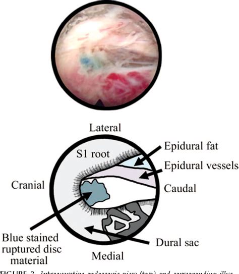 Figure 3 From Percutaneous Endoscopic Interlaminar Discectomy For