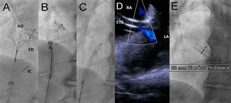 A C Snare Retrieval Of Amplatzer Pfo Occluder D Residual Right To