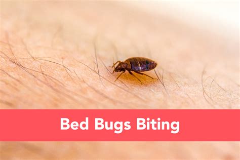 Bed Bugs Biting Home Remedies And Treatment Of Bed Bug Bites Protect