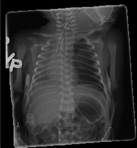 Pneumothoraces) refers to the presence of gas (often air) in the pleural space. Radiological images of neonatal pneumothorax (left ...