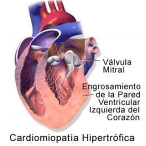 Miocardiopatía hipertrófica EcuRed