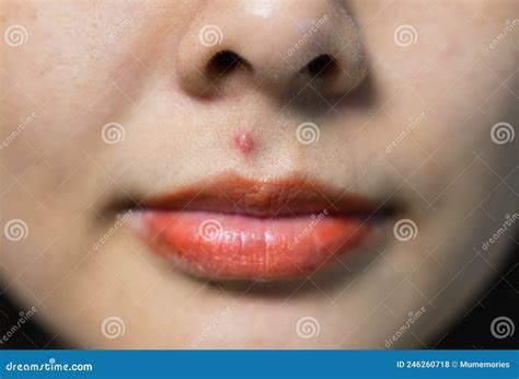 Piel De Acn Inflamada Purulenta En La Cara De Una Mujer Asi Tica Foto