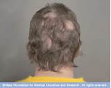 Pictures of Alopecia Mayo Clinic