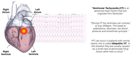 Ventricular Tachycardia In Normal Hearts Idiopathic Vt Melbourne
