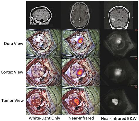 Frontiers Indocyanine Green For Fluorescence Guided Surgery Of Brain