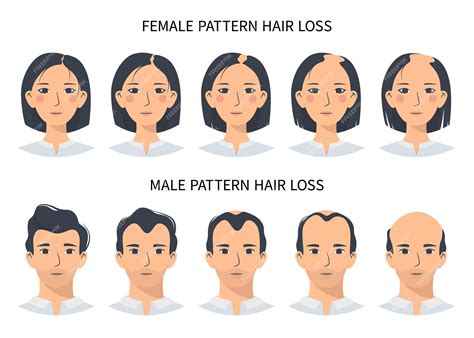 Premium Vector Hair Loss Stages Androgenetic Alopecia Male And Female