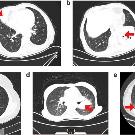 Representative Ct Image Of The Primary Pulmonary Malt Lymphoma