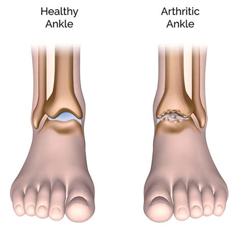 Ankle Arthritis And Degenerative Joint Disease Patient Education