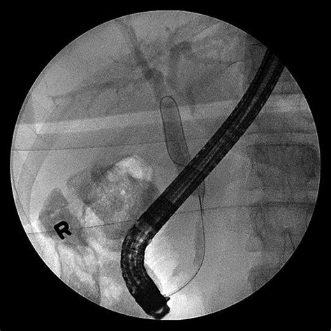 Ercp Showed Cbd Was Cannulated At The Ampulla Using Guidewire Technique