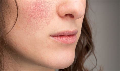 How To Treat Eczema On Face Best Homeopathy Doctor In India US UK Europe