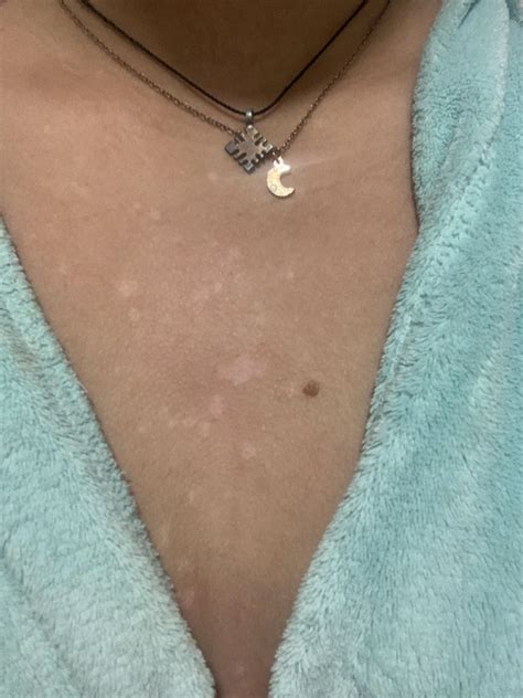 I Noticed These Spots A Couple Weeks Ago On My Chest But I Thought It