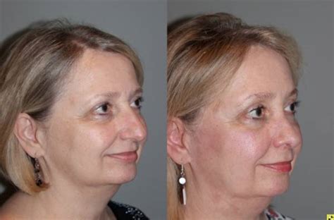 Rhinoplasty 1 Kalos Facial Plastic Surgery