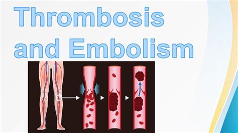 Thrombosis And Embolism Virchows Triad Pulmonary Embolism Types Of