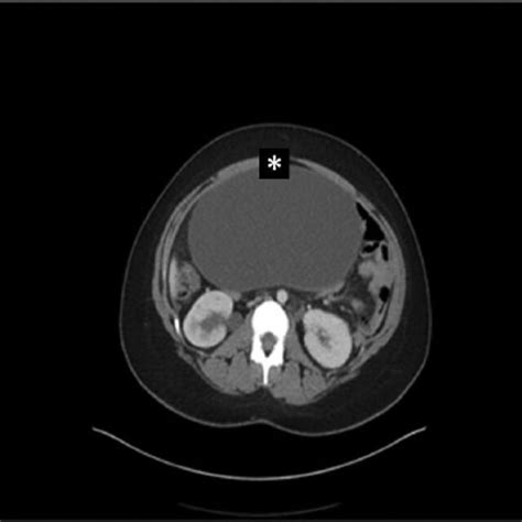 Pelvic Ct Scan