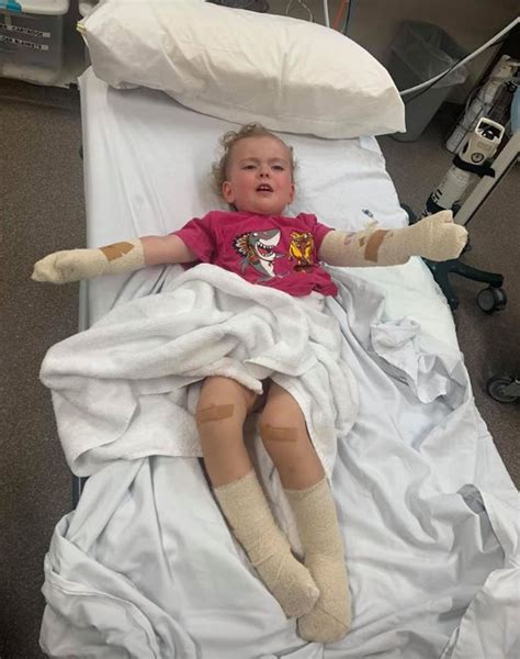 Dads Campfire Warning After Toddler Suffers Horrific Burns During
