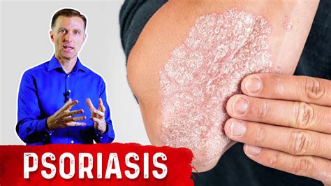 The Best 3 Remedies For Psoriasis Healthy Keto™ Dr Berg
