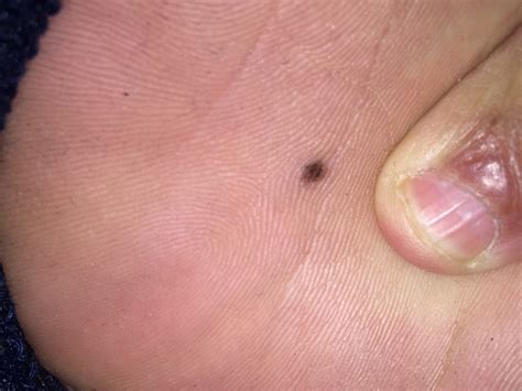 Absolutely Terrified Ive Got Melanoma On The Bottom My Foot Melanoma