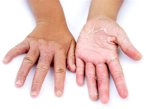 Nine Causes Of Peeling Skin Guardian Life The Guardian Nigeria News Nigeria And World News