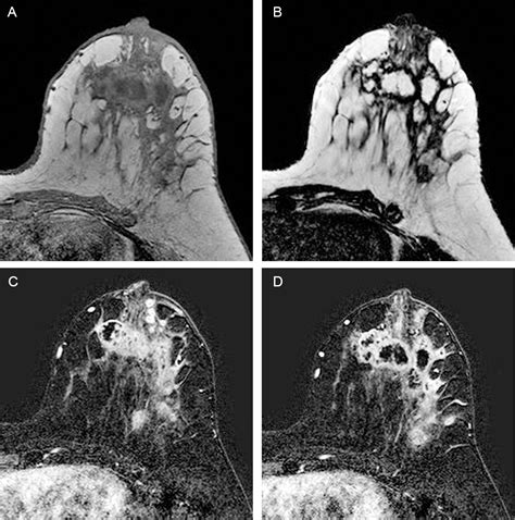 Chronic Granulomatous Mastitis Imaging Pathology And Management