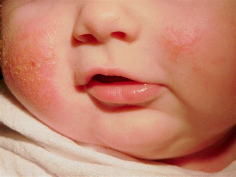 Dermatite At Pica Em Lactentes Fotos Tratamento Com Pomada E