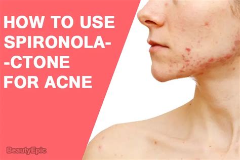 How Effective Is Spironolactone For Acne