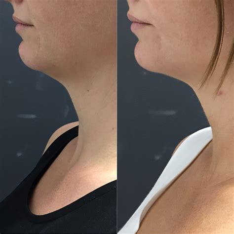 Non Surgical Neck Lift Neck Tightening For Neck Wrinkles Lines
