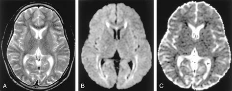 Diffusion Weighted Imaging Of Acute Excitotoxic Brain Injury American