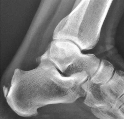 Preoperative Radiograph Showing Haglund Deformity Download