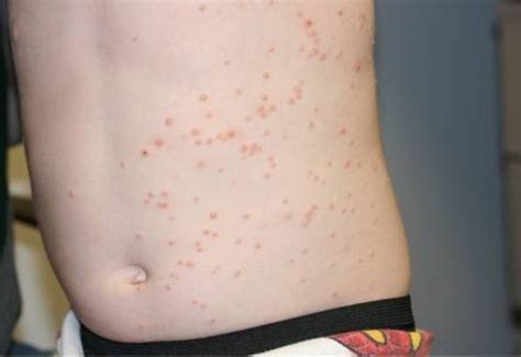 Molluscum Contagiosum A Common Viral Skin Condition In Children