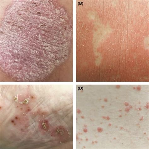 Paradoxical Psoriasis Phenotypes Include Plaque A Erythrodermic B