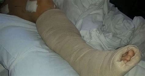 mum reveals horrific broken bones and crushed legs after resting feet on dashboard as car