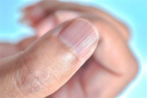 Vertical Lines On Fingernails How To Achieve Healthy Nails