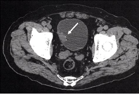 Pdf Urinary Bladder Cancer Showing Surface Calcification On Computed