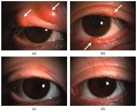 A Year Old Female Changes In Chalazion In Upper And Lower Eyelids