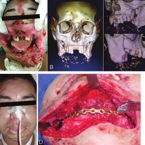 (PDF) A Patient With Severe Lower Face Degloving Injury