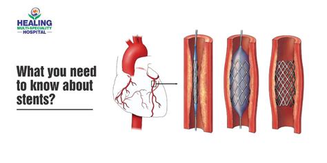 What You Need To Know About Stents Healing Hospital