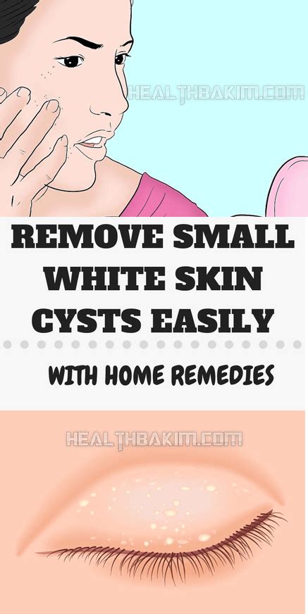 Remove Small White Skin Cysts Easily With Homemade Remedies Health