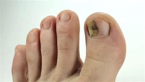 Toenails With Fungal Infection Sick Nail Fungus Of Big Toe Trauma Of