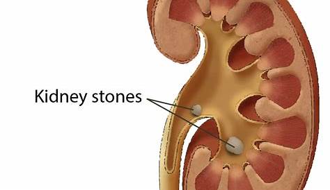 Kidney Stones Symptoms, Risk Factors, and Diagnosis | Saint John’s