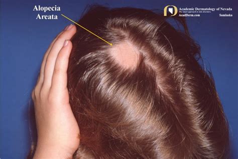 Alopecia Areata Autoimmune Alopecia Academic Dermatology Of Nevada