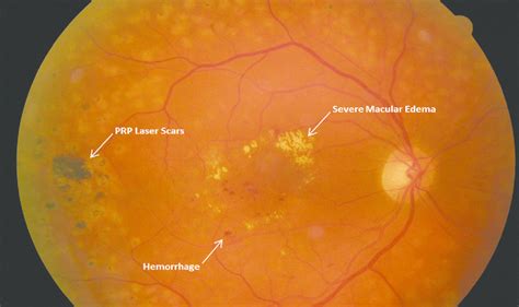 A Diabetic Macular Edema With Panretinal Photocoagulation Prp Right