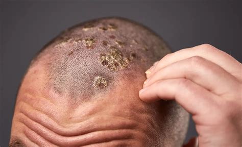 Scalp Psoriasis Symptoms Causes Treatment